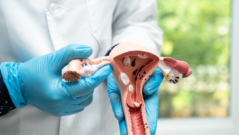 Polip macicy - kiedy jest złośliwy?