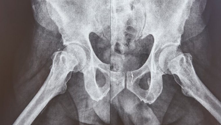 Dlaczego boli miednica i kiedy należy udać się do lekarza z tą dolegliwością?